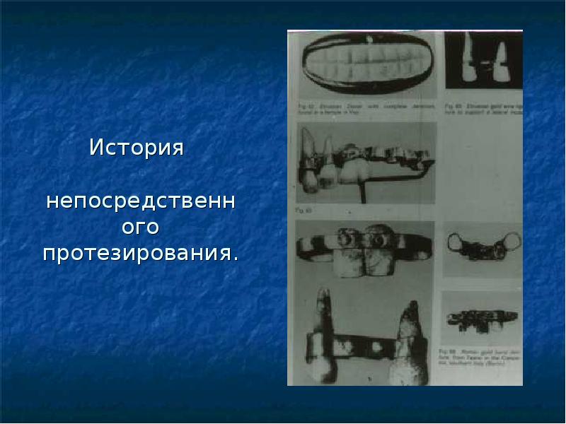 Шины протезы. Непосредственное протезирование. Конструкции шин протезов. Непосредственный протез. Непосредственное протезирование доклад.