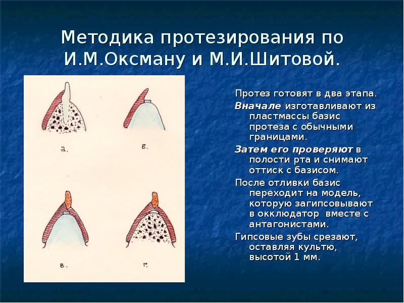 Методика протезирования по И. М. Оксману и М. И. Шитовой. Протез готовят в два этапа. Вначале изгота