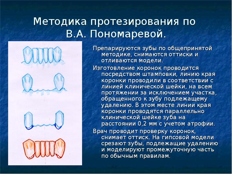 Методика протезирования по В. А. Пономаревой. Препарируются зубы по общепринятой методике, снимаются