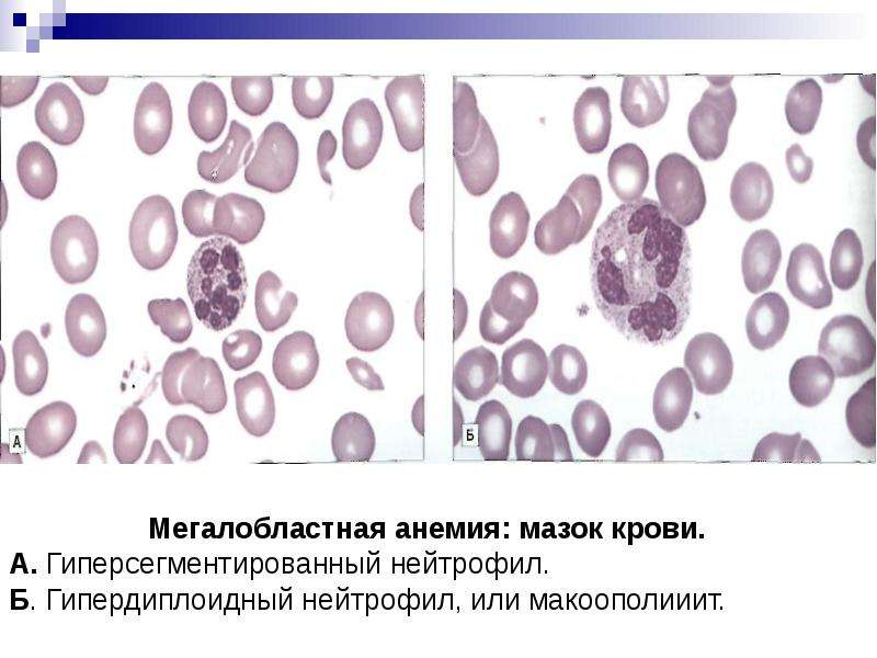 Мегалобластная анемия презентация