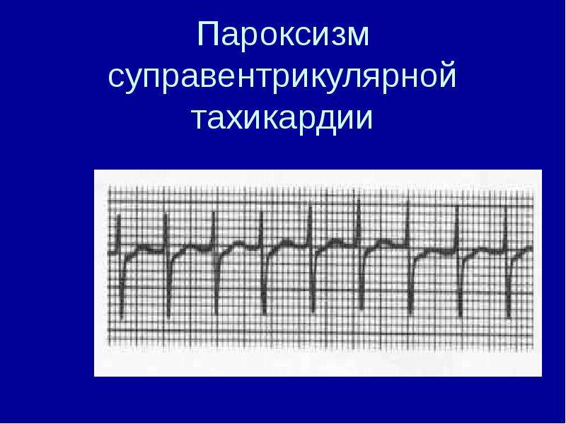 Тахикардия карта вызова