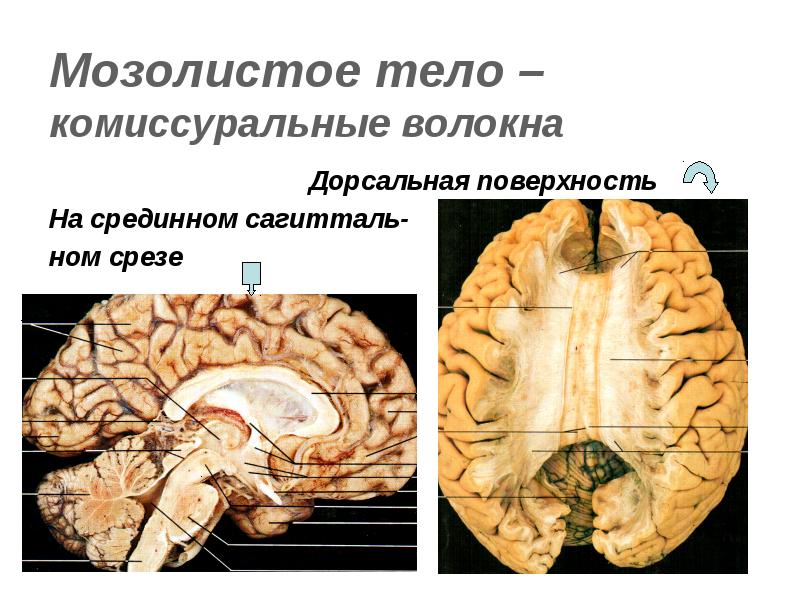 Мозолистое тело. Комиссуральные волокна головного мозга мозолистое тело. Анатомия мозолистого тела головного мозга. Валик мозолистого тела анатомия. Мозолистое тело сагиттальное сечение.