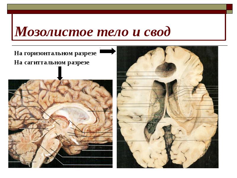 Мозолистое тело. Мозолистое тело и свод мозга. Мозолистое тело анатомия. Валик мозолистого тела анатомия. Строение мозолистого тела головного мозга.