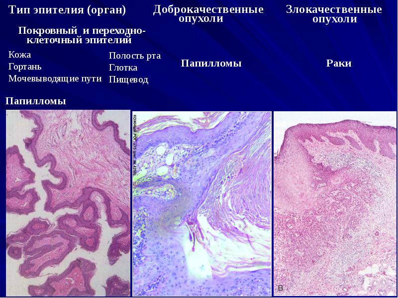 Доброкачественная ткань. Доброкачественная опухоль гистология. Эпителий доброкачественных и злокачественных опухолей. Доброкачественные опухоли эпителия. Злокачественное новообразование гистология.