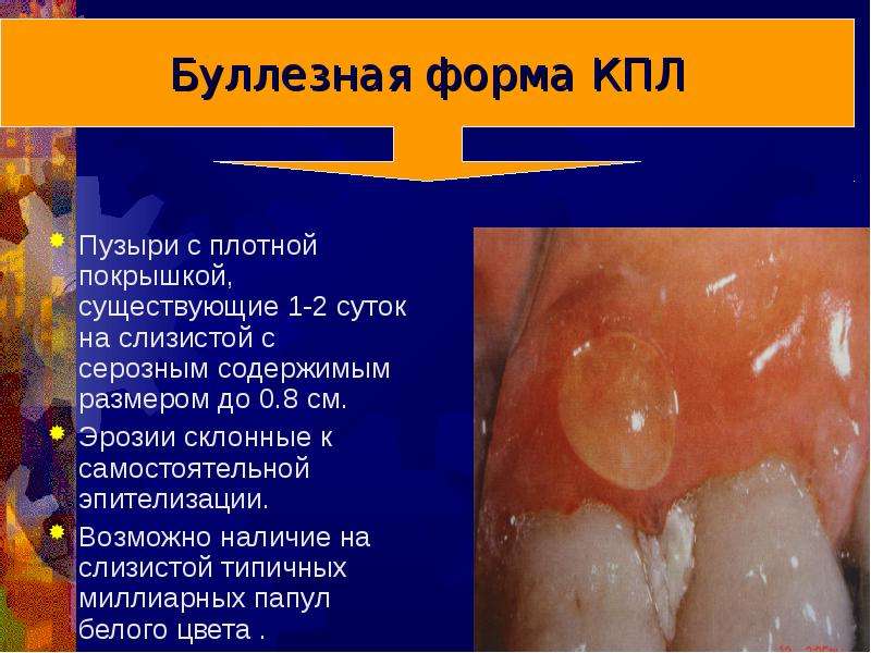 Красный плоский лишай презентация