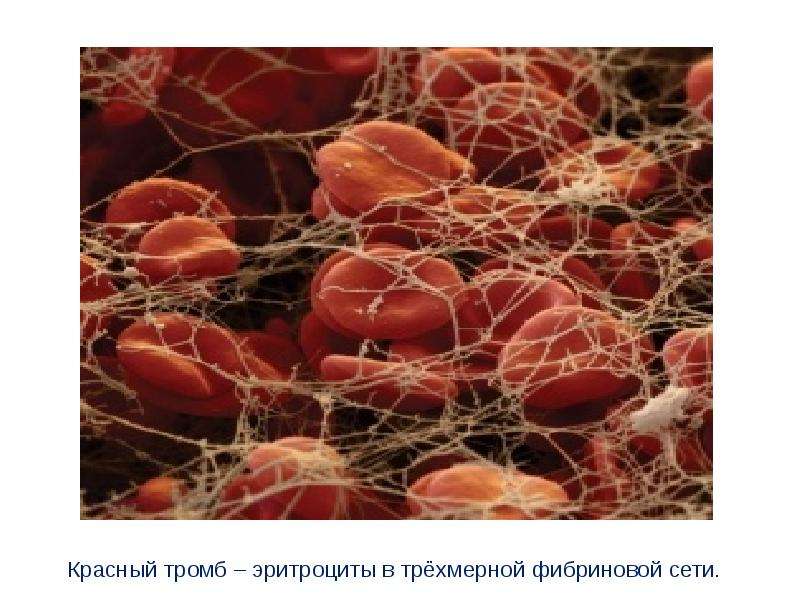 Красный тромб – эритроциты в трёхмерной фибриновой сети.