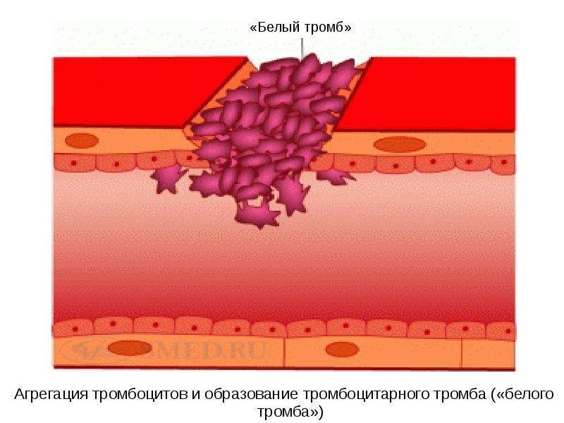 Агрегация тромбоцитов и образование тромбоцитарного тромба («белого тромба»)