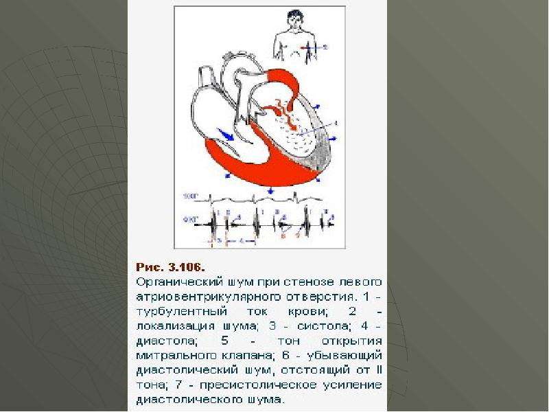 Ревматизм пороки сердца презентация