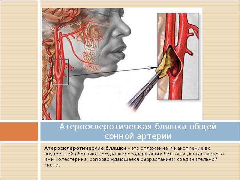   Атеросклеротическая бляшка общей сонной артерии  Атеросклеротические бляшки - это отложение и накопление во внутренней оболочке сосуда жиросодержащих белков и доставляемого ими холестерина, сопровождающееся разрастанием соединительной ткани.
