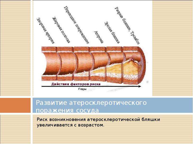   Развитие атеросклеротического поражения сосуда
Риск возникновения атеросклеротической бляшки увеличивается с возрастом.
