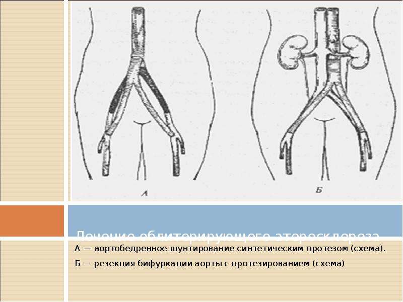   Лечение облитерирующего атеросклероза  А — аортобедренное шунтирование синтетическим протезом (схема). 
Б — резекция бифуркации аорты с протезированием (схема)
