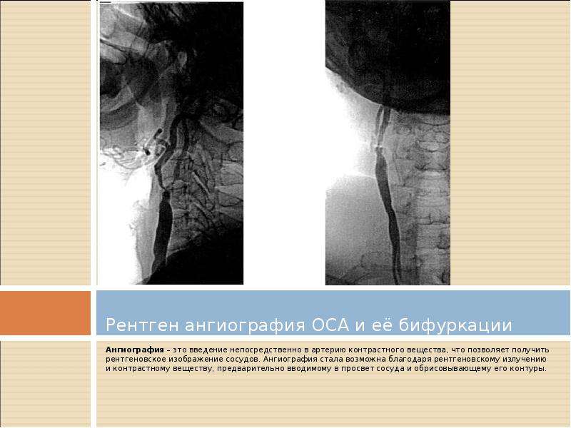   Рентген ангиография ОСА и её бифуркации  Ангиография – это введение непосредственно в артерию контрастного вещества, что позволяет получить рентгеновское изображение сосудов. Ангиография стала возможна благодаря рентгеновскому излучению и контрастному веществу, предварительно вводимому в просвет сосуда и обрисовывающему его контуры.
