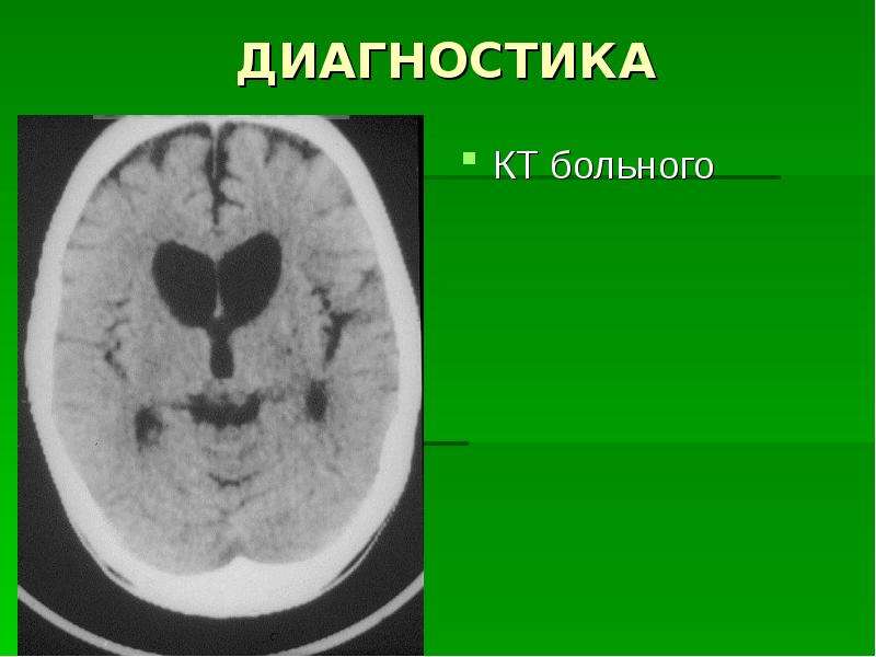 Болезнь хорея гентингтона симптомы и признаки фото лечение