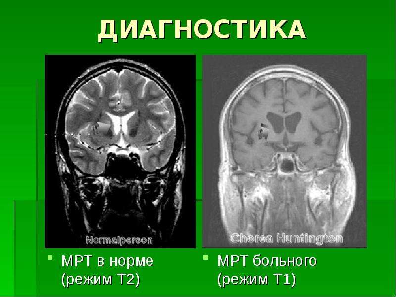 Т1 и т2 взвешенные изображения в мрт