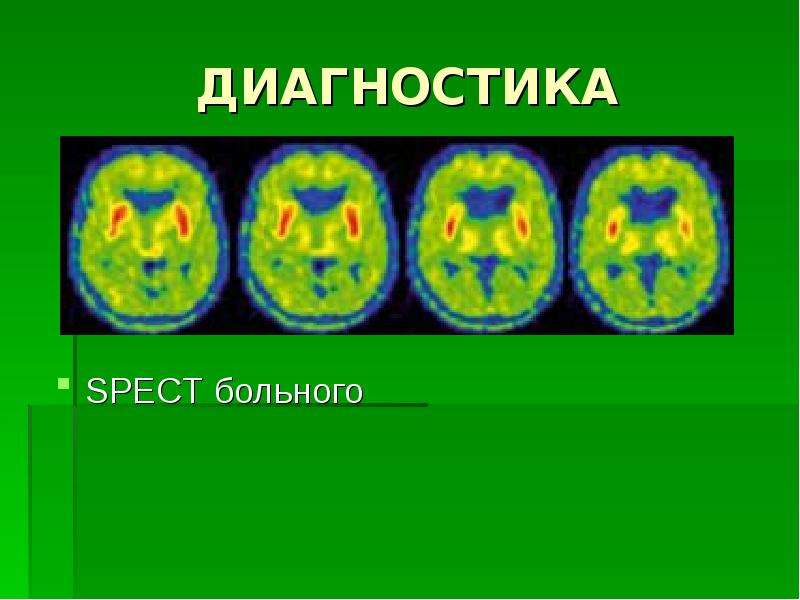 Хорея гентингтона презентация неврология