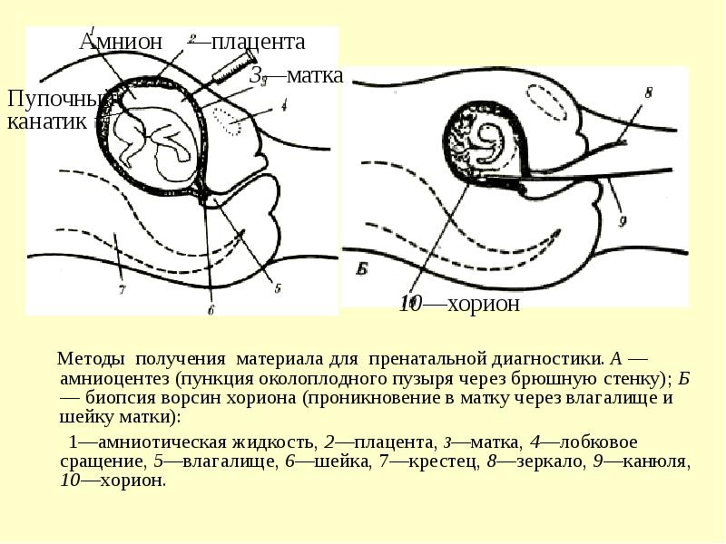 Хорион низко по передней стенке форум