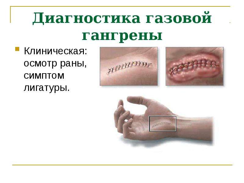 Острая аэробная хирургическая инфекция презентация