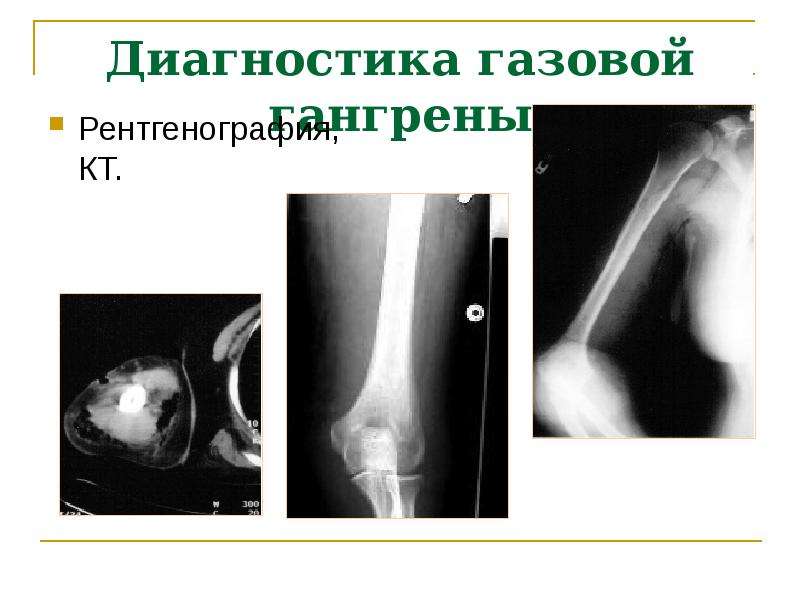 Острая аэробная хирургическая инфекция презентация