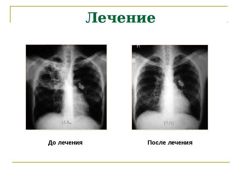 Специфическая хирургическая инфекция презентация