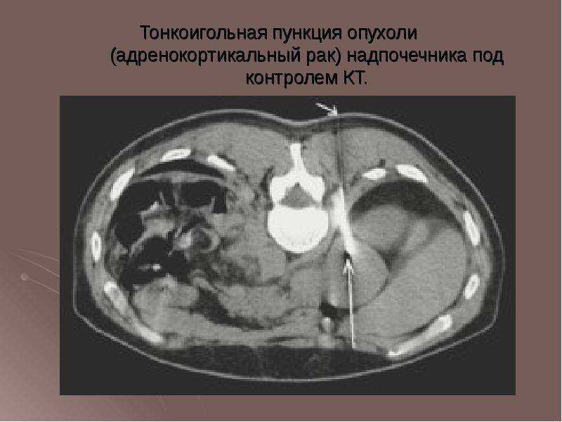 Hu надпочечника