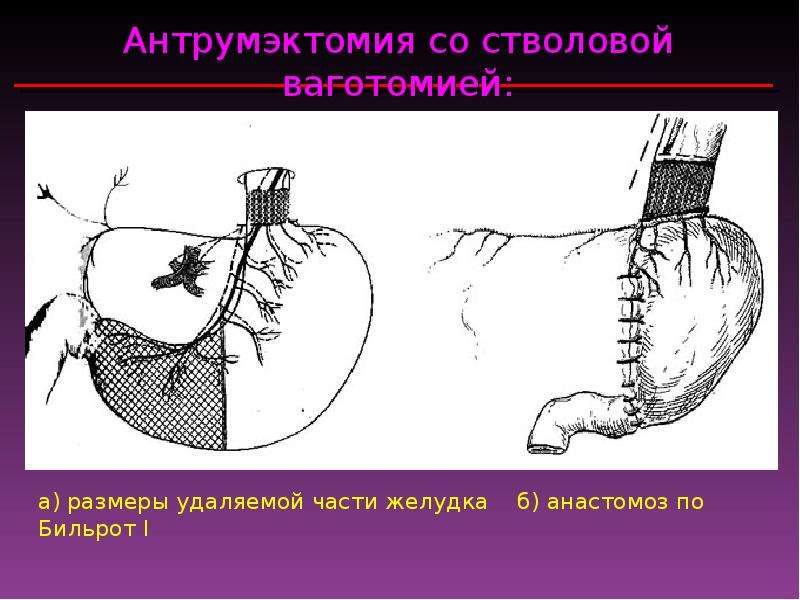 Удаление части. Антрумэктомия желудка. Стволовая ваготомия с антрумэктомией. Стволовая ваготомия с экономной резекцией желудка. Антрумэктомия с ваготомией ход операции.