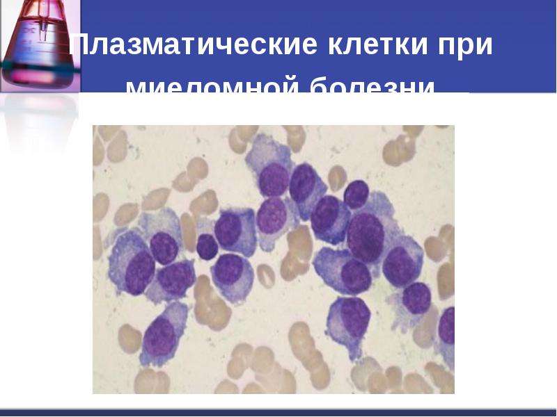 Плазматические клетки при миеломной болезни