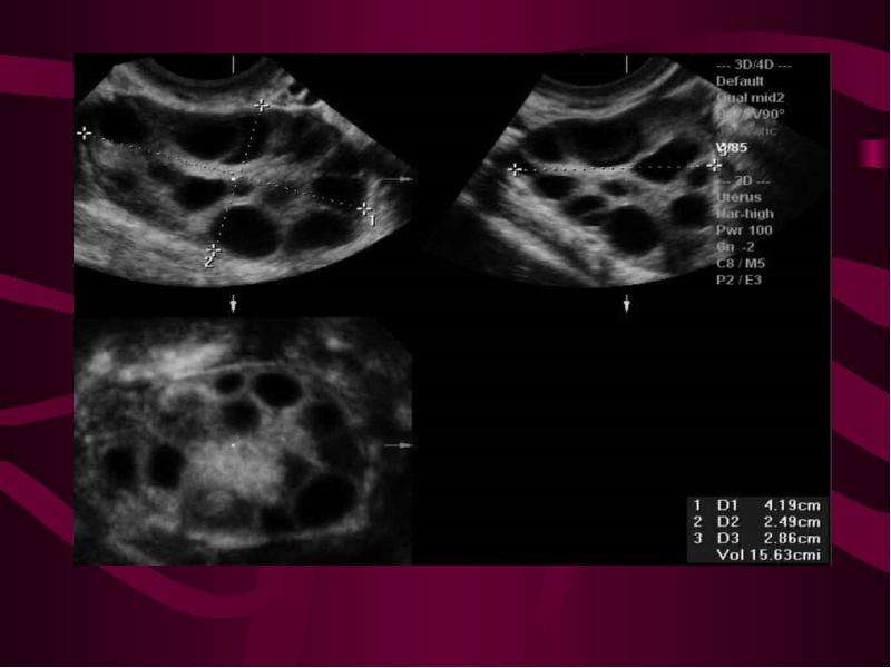 Поликистозные яичники на узи фото