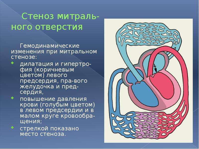 Гемодинамика митральный стеноз схема