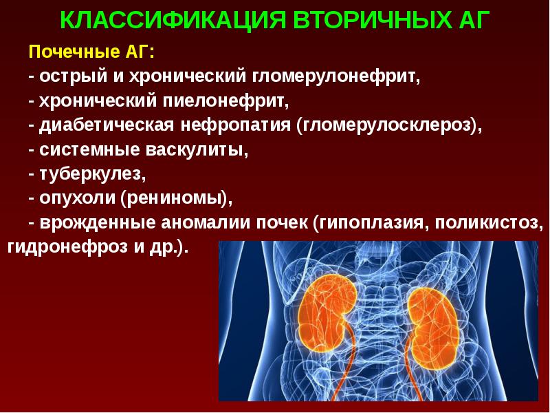 Вторичные артериальные гипертонии. Поликистоз и артериальная гипертензия. Вторичной( симптоматической) гипертензии. Врожденные аномалии почек. Гипертензия при пиелонефрите.