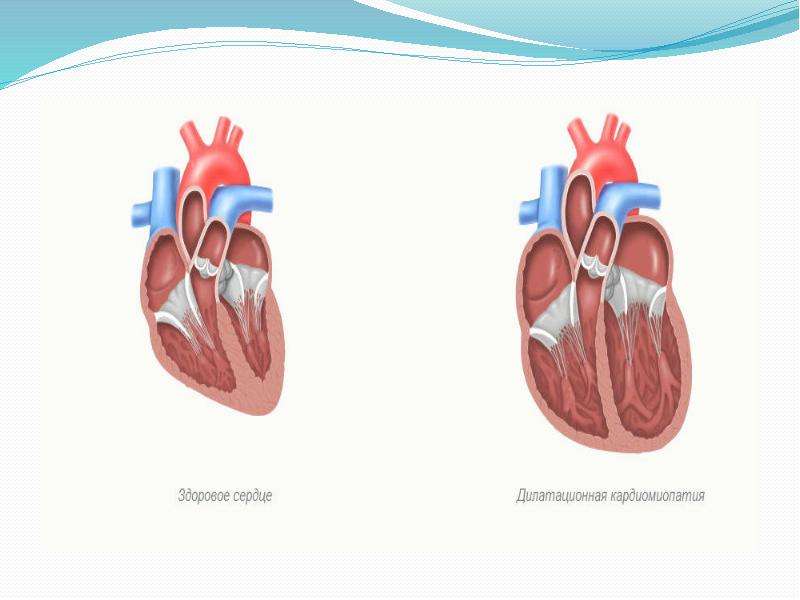 Кардиомиопатии у детей презентация