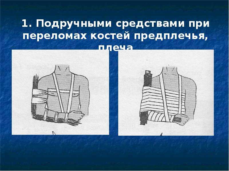 Подручные и табельные средства транспортной иммобилизации. Средства иммобилизации при переломах. Подручные средства при переломе. Подручные средства для иммобилизации конечности при переломах. Иммобилизация подручными средствами при переломе плеча.