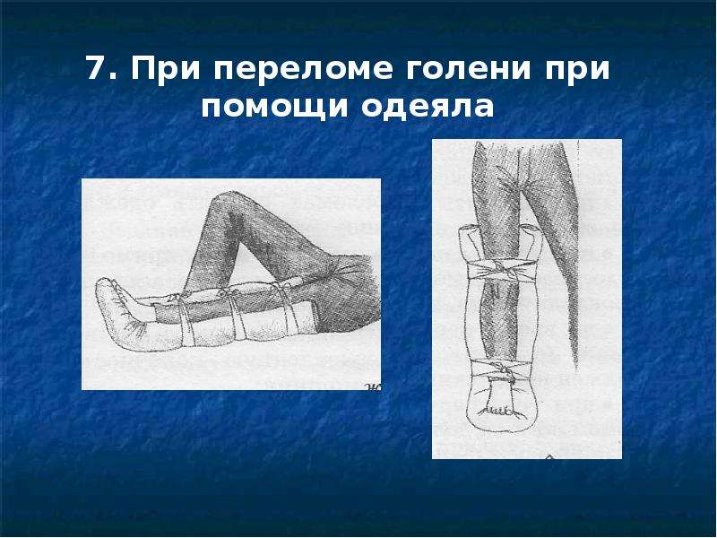 Переломы нижних конечностей. При переломе голени при помощи одеяла. Переломы нижних конечностей презентация. Переломы нижней конечности презент.