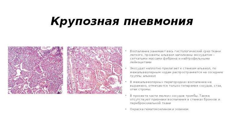 Крупозная пневмония рисунок