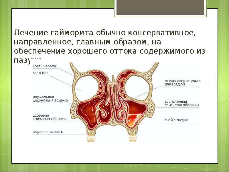 Пазухи лечение