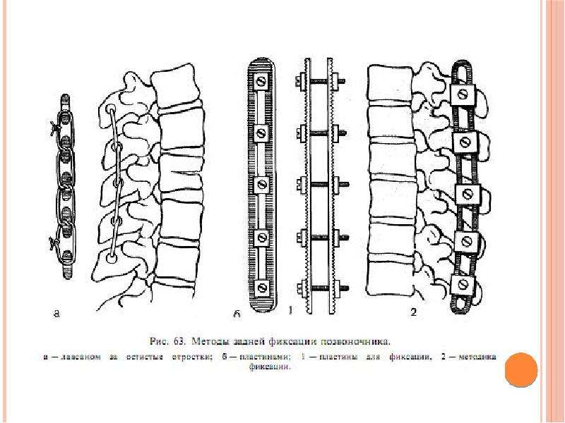 Пластинка позвонка. Остеосинтез остистых отростков позвонков. Остеосинтез позвоночника пластиной. Системы задней внутренней стабилизации позвоночника. Методы фиксации при переломе позвоночника.
