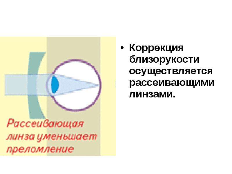 Коррекция близорукости. Коррекция миопии. Правила коррекции миопии.