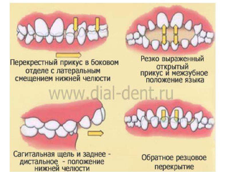 Резко выраженный. Зубочелюстные аномалии. Аномалии и деформации зубочелюстной системы. Зубочелюстные патологии. Аномалии зубочелюстной системы у детей.