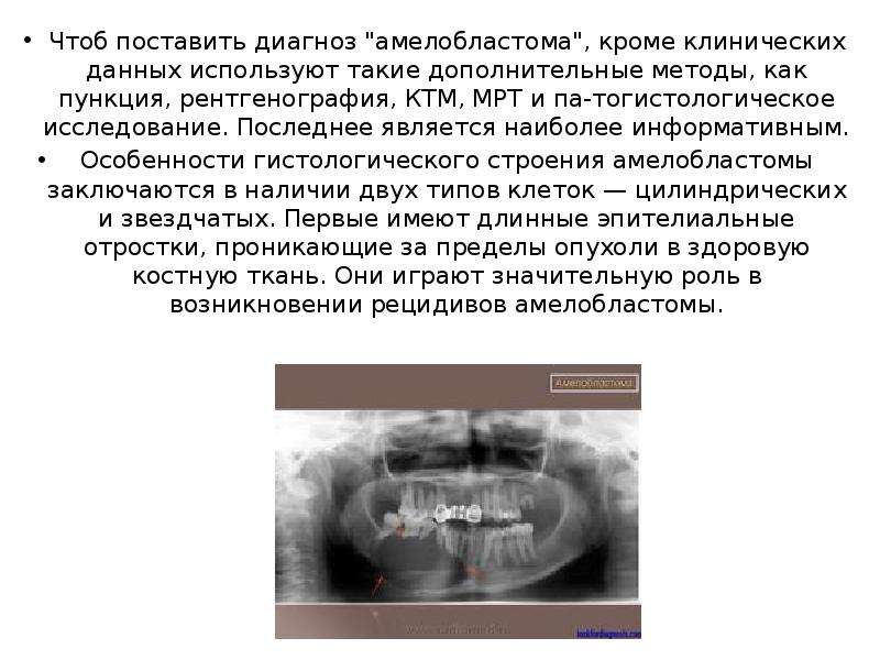 Клиническая картина сложной и составной одонтомы характеризуется