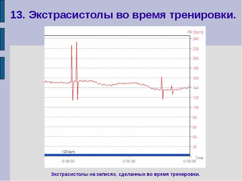 Записи р. Экстрасистолы до 10 в минуту. Изменение r-r интервала времени. Экстрасистола после тренировки. Перед экстрасистолой интервал r r.