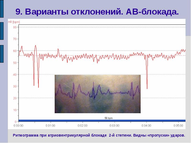 Сердце пропускает. Ритмограмма сердца. Ритмограмма сердца как делают. Ритмограмма Геология. Датчики ритмограммы сердца.