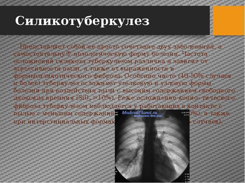 Нехарактерным для клинической картины неосложненного силикоза является