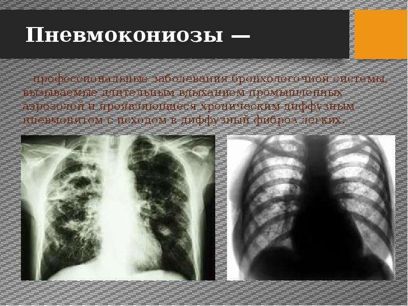 Пневмокониозы рентгенологическая картина