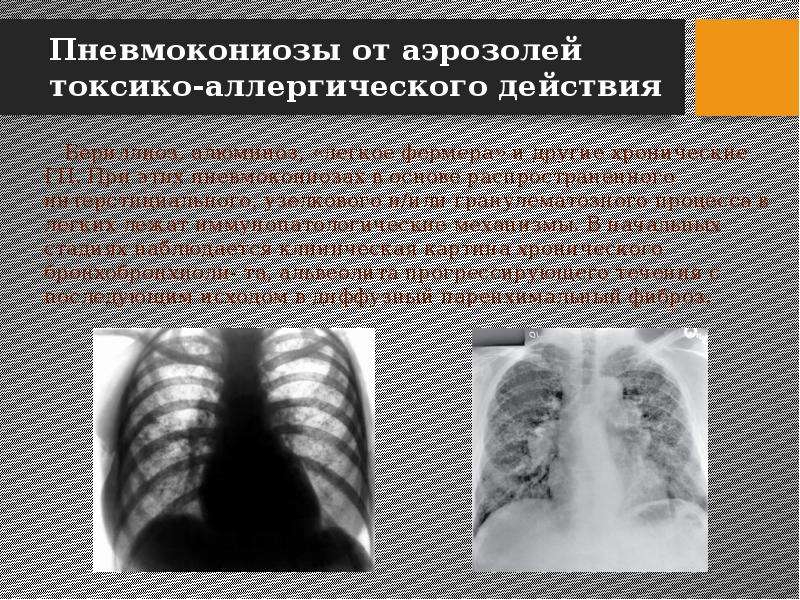 Пневмокониозы профессиональные болезни презентация