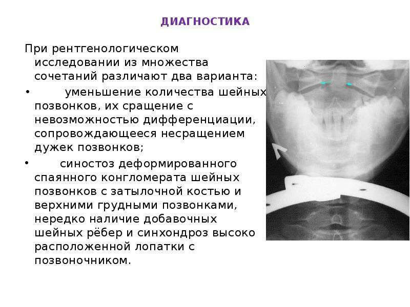 Дужки шейных позвонков