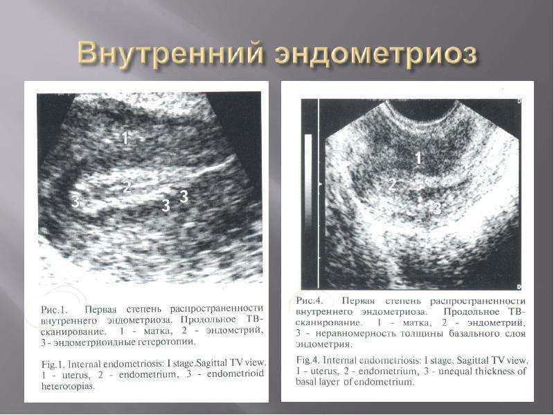 Как выглядит эндометриоз на узи фото