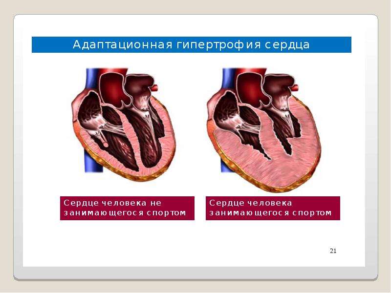 Гипертрофия миокарда рисунок