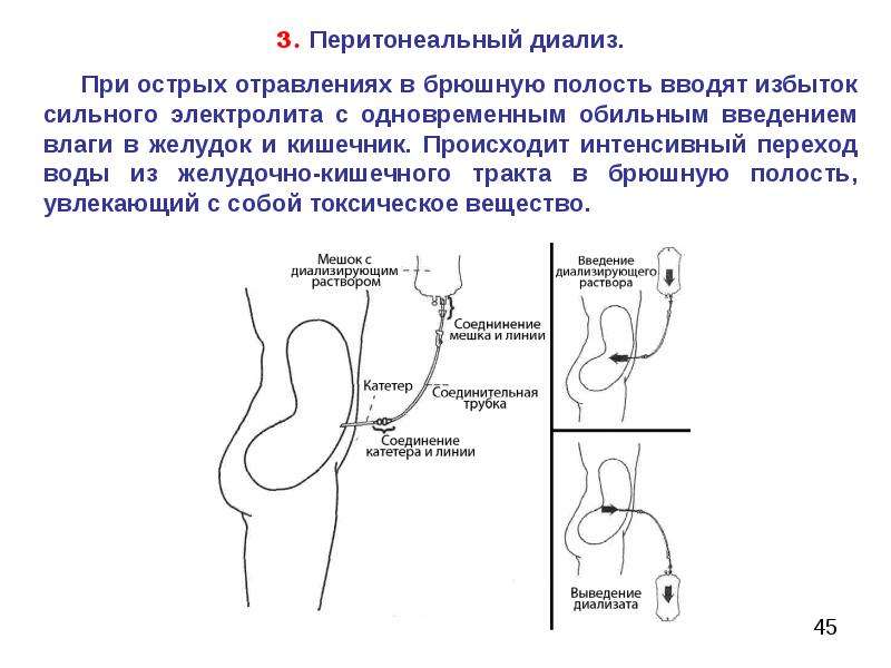 Перитонеальный диализ. Перитонеальный диализ при отравлениях. Острый перитонеальный диализ. Диализ брюшной полости. Брюшная полость перитонеальный диализ.