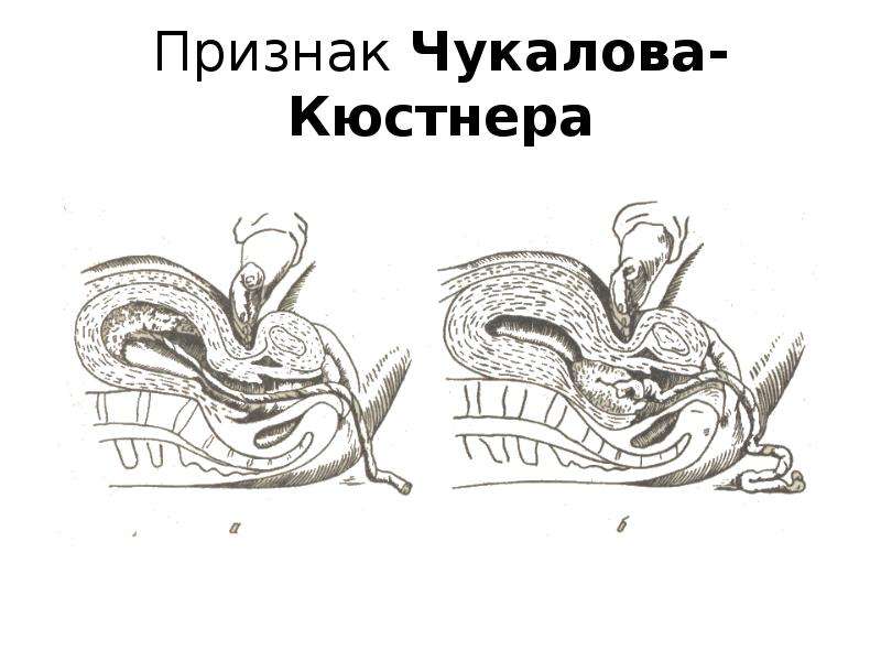 3 период родов это. Признак Кюстнера Чукалова. Признак Чукалова-Кюстнера положительный. Признак Чукалова Кюстнера в акушерстве. Признак отделения последа Кюстнера-Чукалова.