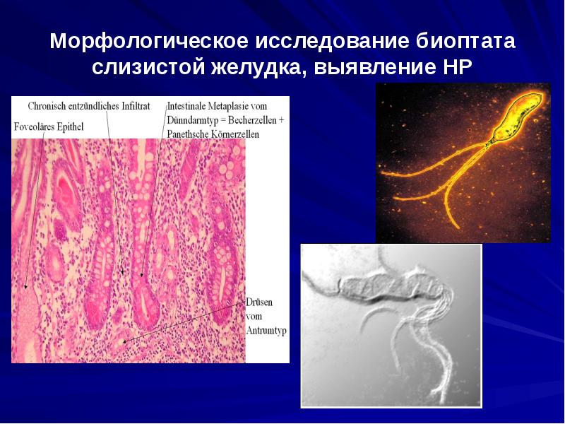 Морфологическое исследование биоптата слизистой желудка, выявление НР
