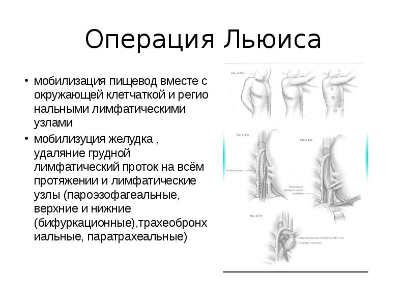 Операция льюиса схема